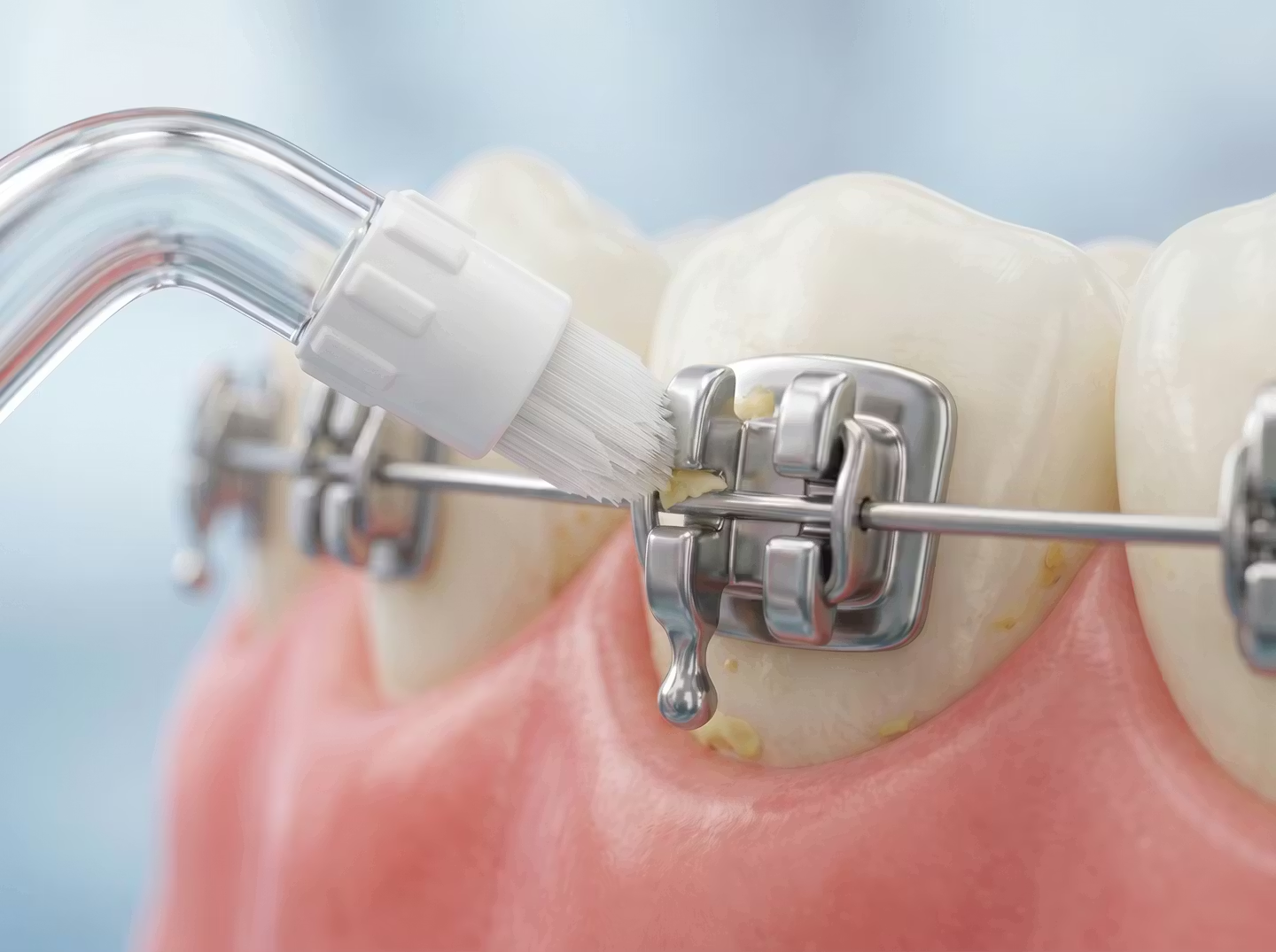 Ugello ortodontico Waterpik